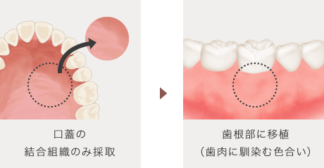 口蓋の結合組織のみ採取 → 歯根部に移植（歯肉に馴染む色合い）